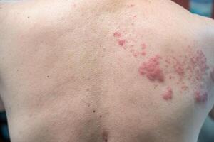 Shingles Disease, Herpes zoster, varicella-zoster virus. skin rash and blisters photo