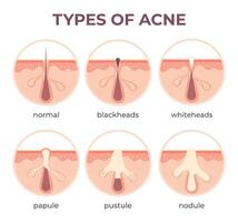 acné tipos anatomía. espinilla enfermedades en corte ver espinilla, cístico y cabeza blanca estructura de piel y poro infección vector infografía