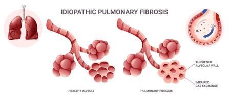 Idiopathic pulmonary fibrosis infographic. Vector illustration isolated on white background