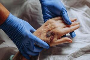 A bruise on the hand of an elderly person. Known as senile purpura. Caused by the fragility of the skin and blood vessels in old age. Elderly care photo