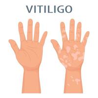 manos con dermatológico enfermedad vitíligo. medicina concepto. bandera, póster, vector