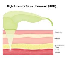 High-Intensity Focus Ultrasound Science Design Vector Illustration