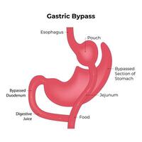 Gastric Bypass Science Design Vector Illustration Diagram