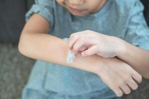 pequeño asiático Niños manos peladura apagado seco piel en su brazo. piel problemas. foto