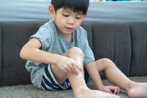 Little Asian boy's hands peeling off dry skin on his legs. Skin problems. photo