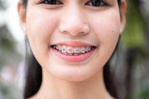 Portrait of a young asian woman with braces on her teeth photo