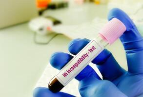 Hemolytic Rh factor test also known as Rh incompatibility or Rh-hemolytic disease test. photo