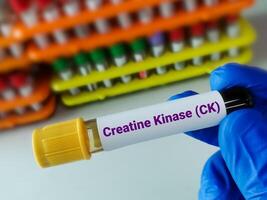 Scientist holding blood sample for Creatinine Kinase. Creatinine Phosphokinase test. Myositis. photo