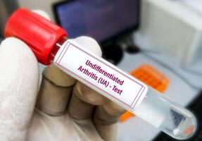Synovial fluid analysis for Non Specific Inflammatory Arthropathies or Undifferentiated arthritis Test. photo