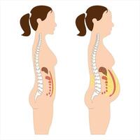 Visceral fat and subcutaneous fat accumulate around organs. Medicine and health diagram about belly fat. vector