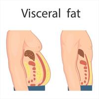 Medical poster about visceral fat. Abdominal fat surrounds the inner doors of the abdominal cavity. Overweight disease concept. Weight loss, liposuction, and diet. vector