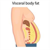 Medical poster about visceral fat. Abdominal fat surrounds the inner doors of the abdominal cavity. Overweight disease concept. Weight loss, liposuction, and diet. vector