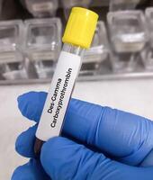 Blood sample for Des gamma carboxy prothrombin or DCP test, to help evaluate whether treatment for one type of liver cancer, hepatocellular carcinoma. photo