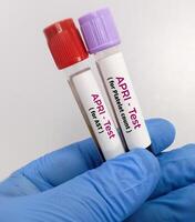 Blood sample for APRI or AST to Platelet Ratio Index test, liver disease. photo