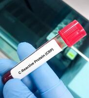 Blood sample for CRP or C reactive protein test used to identify inflammation or infection in the body photo