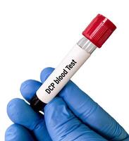 Blood sample for Des gamma carboxy prothrombin or DCP test, to help evaluate whether treatment for one type of liver cancer, hepatocellular carcinoma or HCC. white background. photo