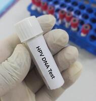 Testing tube with vaginal fluid sample for HPV DNA test, Human papilloma virus, cervical cancer. A medical testing concept in the laboratory photo