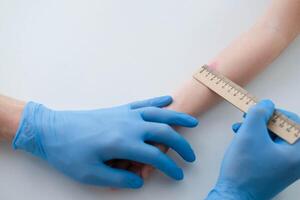de cerca fotografía de un niño mano con un rojo Mancha reacción a un mantoux prueba 72 horas después inyección. un enfermero en azul guantes usos un regla a cheque el reacción. foto