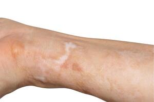 cicatrices en el brazos. causado por un accidente, caliente petróleo salpicado sobre el brazo área. foto