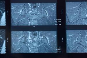 MRI sacroiliac articulation. Study of ankylosing spondyloarthritis patient. photo