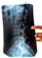 X ray of the lumbar spine, spine on x-ray photo