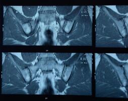MRI sacroiliac articulation. Study of ankylosing spondyloarthritis patient. photo