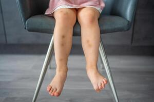 Close up of stains bruise wound on legs of little girl. Extravasation blue, purple on skin. Active childhood concept photo