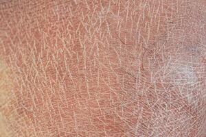 Closeup view of dry human skin . photo