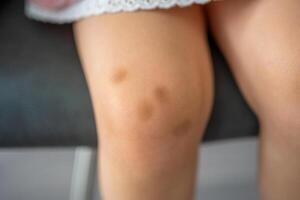 Close up of stains bruise wound on legs of little girl. Extravasation blue, purple on skin. Active childhood concept photo