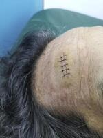 Stitched wound in forehead area from accident photo