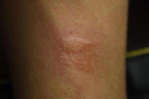 Allergy skin. Allergic reactions on the skin in the form of swelling and redness photo