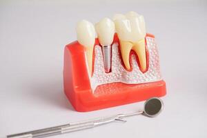 Dental implant, artificial tooth roots into jaw, root canal of dental treatment, gum disease, teeth model for dentist studying about dentistry. photo