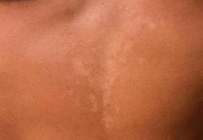 Sunburn on the skin of the stomach. Exfoliation, skin peels off. Dangerous sun tan photo