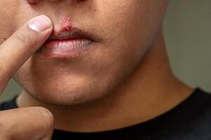Herpes virus and infection treatment. Men lips affected  by herpes blisters photo