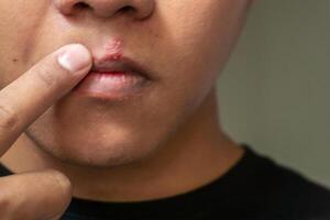 herpes virus y infección tratamiento. hombres labios afectado por herpes ampollas foto