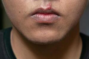 Herpes virus and infection treatment. Men lips affected  by herpes blisters photo