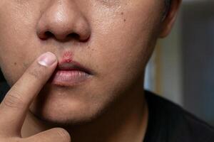 Herpes virus and infection treatment. Men lips affected  by herpes blisters photo