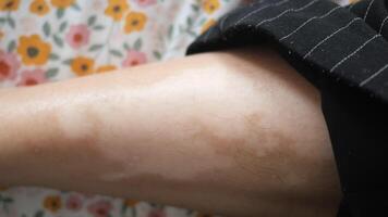 feet with vitiligo skin condition. video