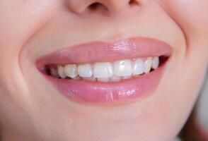 Closeup of female patient showing her beautiful white teeth while having treatment at dental clinic, dentist hands in rubber gloves holding dental tools photo