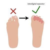 Interdigital separator, toe corrector, silicone Used for calluses and corns, finger deformities, arthrosis, arthritis, gout, vascular disorders, pain in the finger joints. Vector illustration