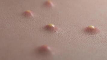 Akne Pops aus von das Haut weil von verstopft Poren video