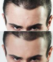 Before and after cosmetic operation. Young man portrait photo