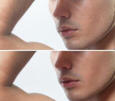 Before and after cosmetic operation. Young man portrait photo