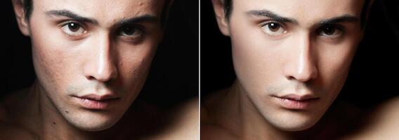 Before and after cosmetic operation. Young man portrait photo