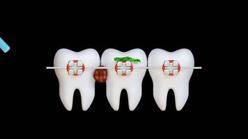 Braces that have been cleaned 3d animation video