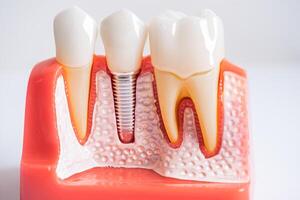 Dental implant, artificial tooth roots into jaw, root canal of dental treatment, gum disease, teeth model for dentist studying about dentistry. photo