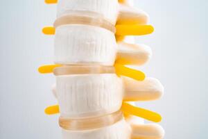Lumbar spine displaced herniated disc fragment, spinal nerve and bone. Model for treatment medical in the orthopedic department. photo