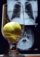 médico metáfora. Fresco manzana terminado radiografía resultados película de humano cráneo foto