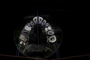 CT image of the teeth of a 9-year-old child, with baby teeth, in different projections. CBCT of two jaws. photo