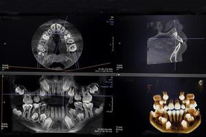 CT image of the teeth of a 9-year-old child, with baby teeth, in different projections. CBCT of two jaws. photo